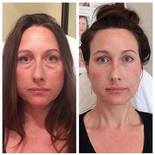 Menina antes e depois do rejuvenescimento facial a laser