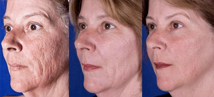 Resultado após procedimento de rejuvenescimento da pele facial a laser