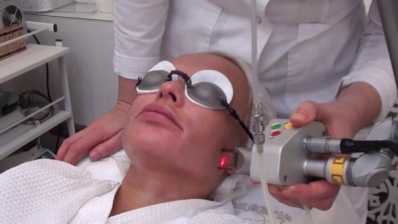 Tratamento com feixe de laser de áreas problemáticas da pele do rosto