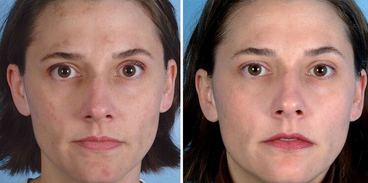 antes e depois do rejuvenescimento da pele com o dispositivo