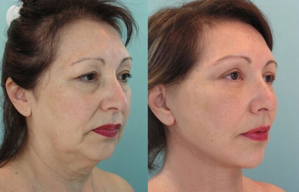 foto antes e depois do rejuvenescimento da pele