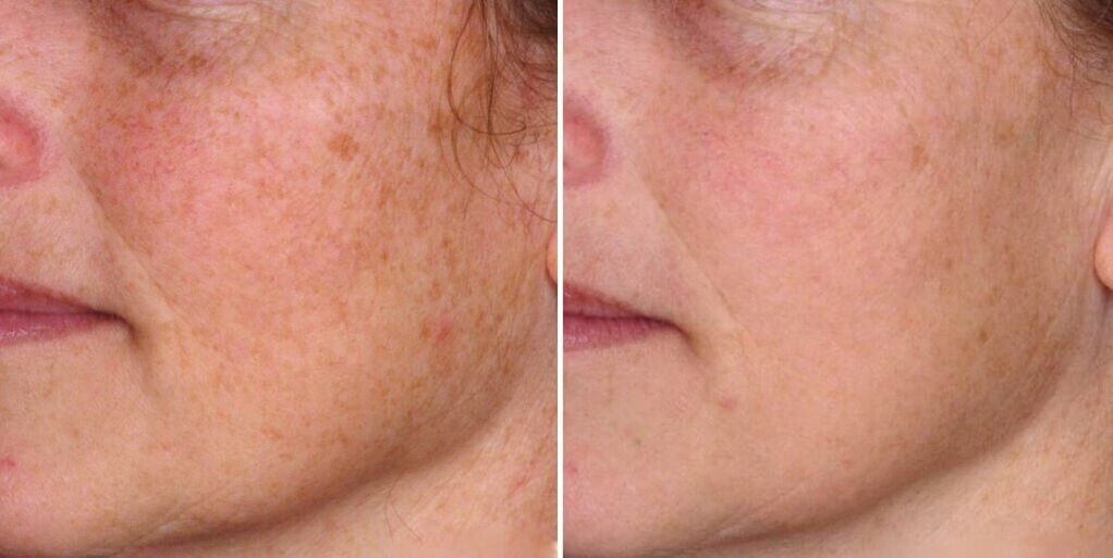 pele do rosto antes e depois do rejuvenescimento